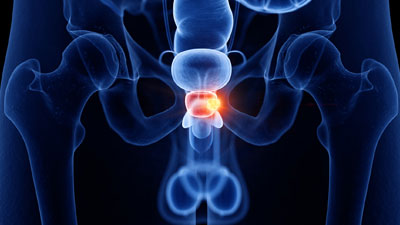 Prostate cancer and prostatectomy